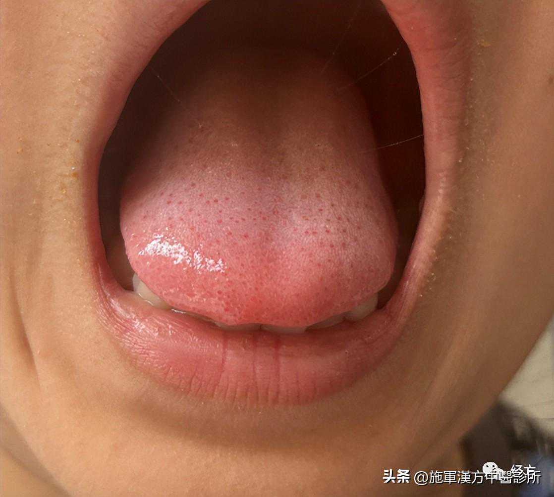 【龚雪梅用经方】《外台》茯苓饮案例3则
